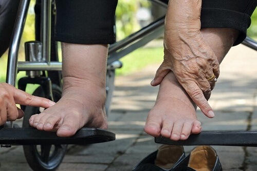 Trattamento del piede diabetico: cosa fare?
