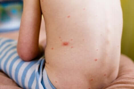 Bambino seduto sul letto con dermatite atopica sulla schiena.