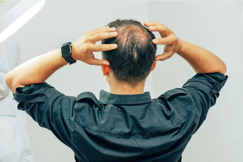 I diversi tipi di alopecia.