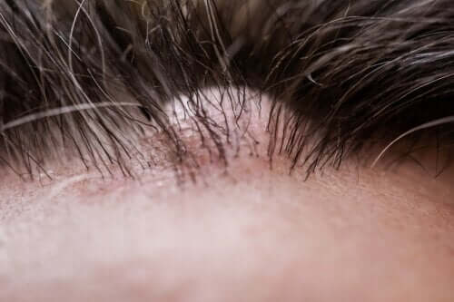 Il Dermatofibroma Caratteristiche E Cura Vivere Piu Sani
