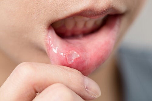 Afte della bocca nel bambino e come trattarle