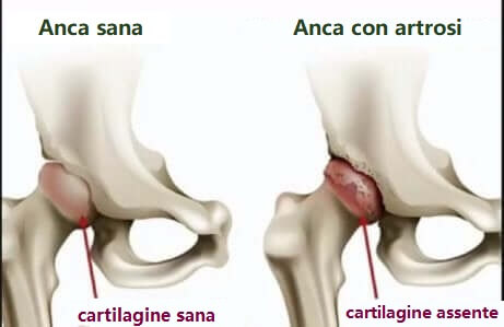 Anca sana e anca con artrosi