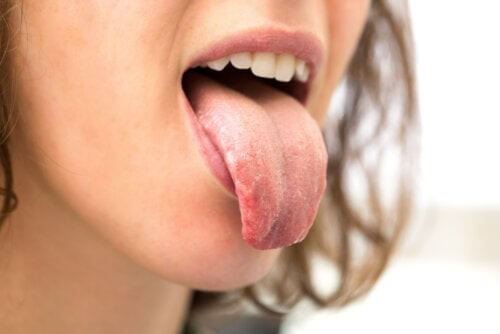 La secchezza della bocca è un sintomo del diabete