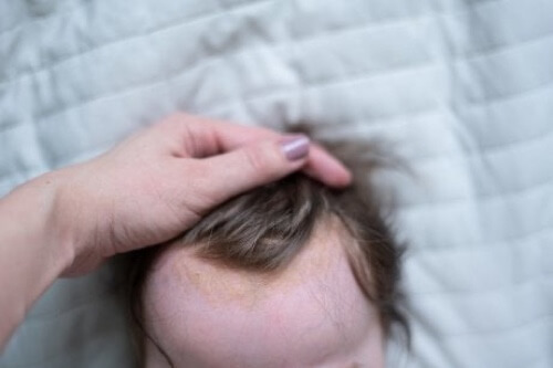 Neonato con crosta lattea.