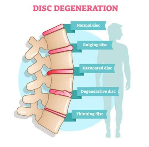 Sintomi e cause della discopatia degenerativa.