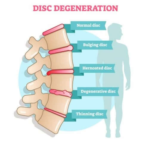 Discopatia degenerativa: sintomi e cause