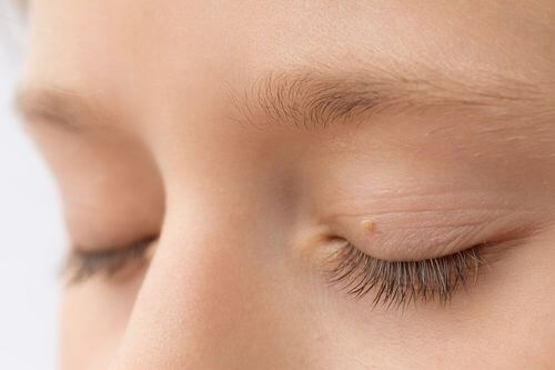 Xantelasma sulle palpebre.