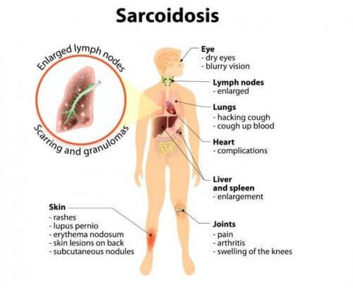 Sarcoidosi: cause, sintomi e trattamento