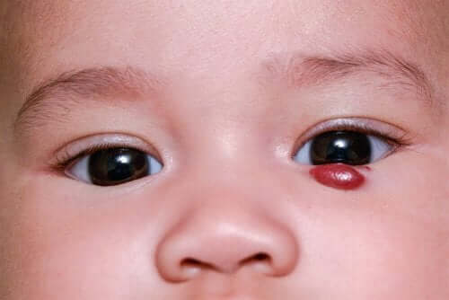 Emangioma infantile: cause e trattamento