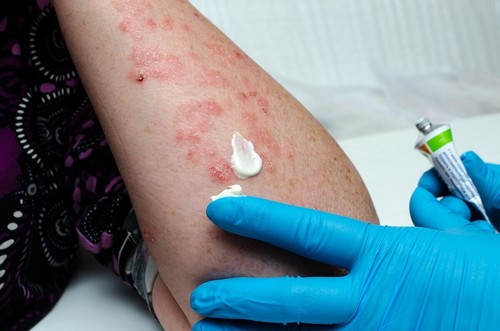 Vescicole nel braccio da herpes zoster.