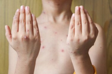 Herpes Zoster nel bambino: cause, sintomi e terapia