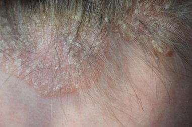 la psoriasi del cuoio capelluto: sintomi e trattamento
