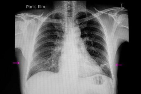 Atelettasia polmonare: sintomi e cause
