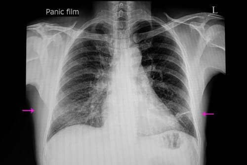 Radiografia che evidenzia atelettasia polmonare.