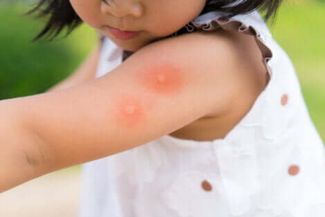 Perché le zanzare pungono, bambina con punture sul braccio