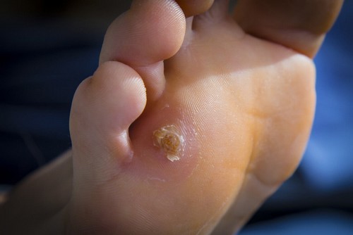 Calli e duroni ai piedi.