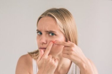 Eliminare i foruncoli con 5 rimedi naturali