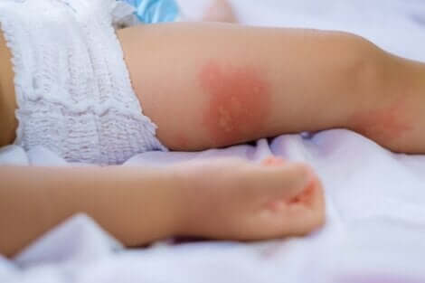 Dermatite da pannolino.