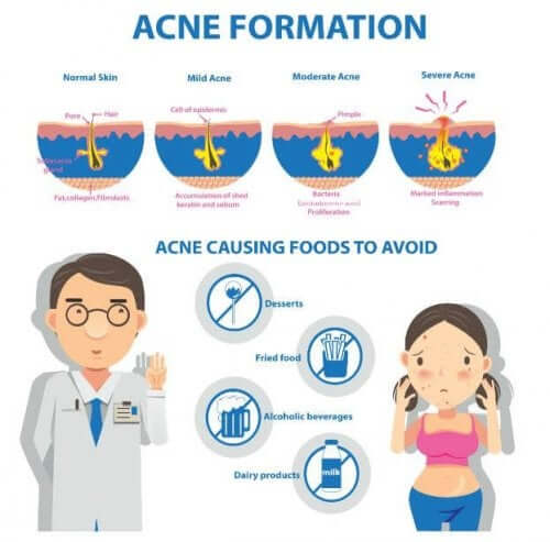 Formazione della acne cistica.