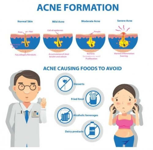 L'acne cistica: cause e sintomi del problema