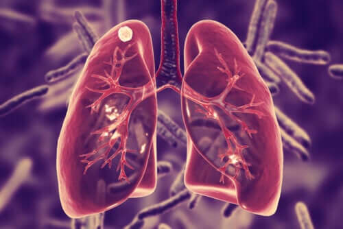 Tubercolosi polmonare: causa e sintomi?