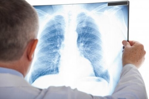 Radiografia ai polmoni.