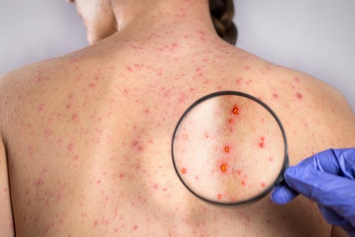 Rush cutaneo da rosolia.