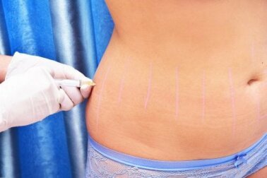 Lipoterapia: cos'è e a che cosa serve?