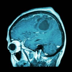 Vaccino per il tumore al cervello: presto in commercio?
