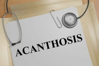 Acanthosis nigricans: cause e sintomi