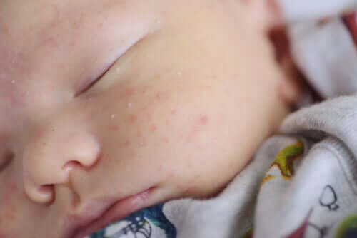 Cura della crosta lattea e dell’acne neonatale