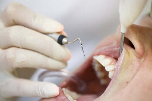 Piorrea o parodontite: cos'è e come trattarla