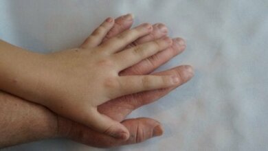 Acromegalia: cos'è e quali sono i sintomi