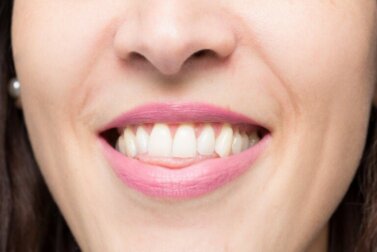 Morso aperto: cos'è e come si corregge?