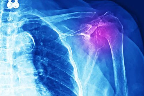Radiografia per diagnosticare una tendinite alla spalla.