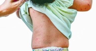 Complicazioni della rosolia e come prevenirle