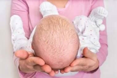 Testa di un neonato con crosta lattea.
