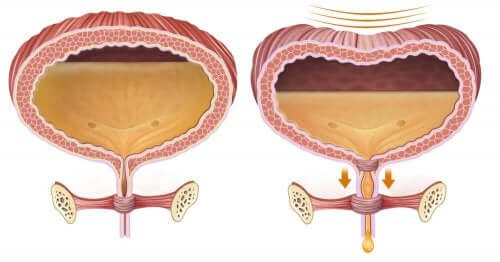 Trattamento della ritenzione urinaria postoperatoria.