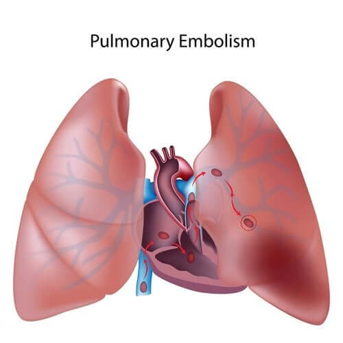 Tromboembolia polmonare: tutto quello che c’è da sapere