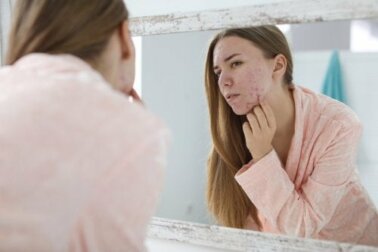 Acne ormonale: fattori scatenanti e cure