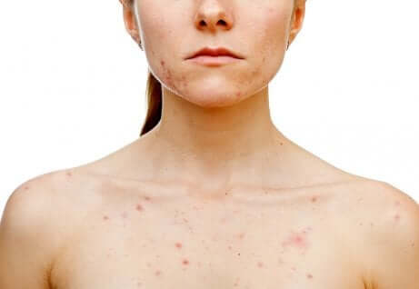 Acne ormonale nel corpo.