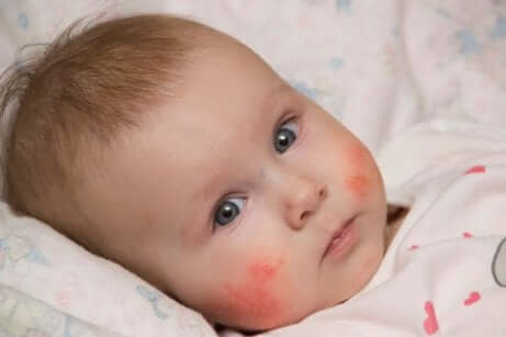 Bambino piccolo con dermatite atopica.