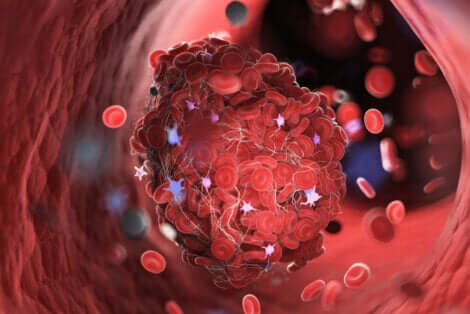 Tromboflebite e coagulo di sangue nella vena.