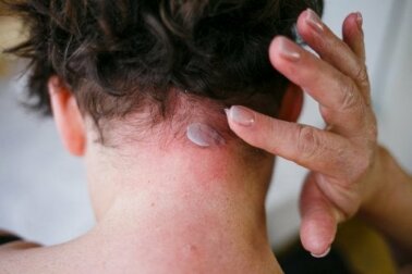 La dermatite seborroica: sintomi e trattamento