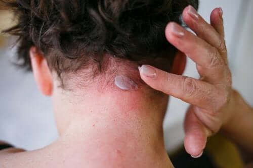 La dermatite seborroica: sintomi e trattamento