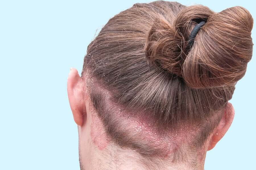 Donna con dermatite seborroica.