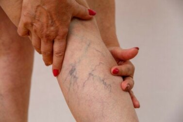 Tromboflebite: cause, sintomi e trattamento