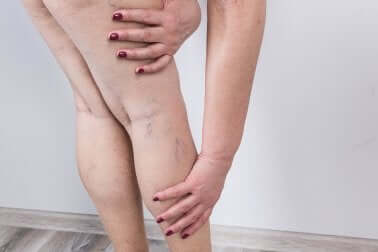 Gonfiore alle gambe.