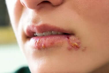 Ragazza con herpes sulla bocca.