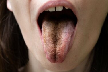 Lingua nera villosa: cause, sintomi e consigli